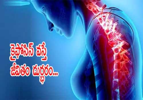 కైఫోసిస్ వస్తే జీవితం దుర్భరం..... | kyphosis treatment| A technique